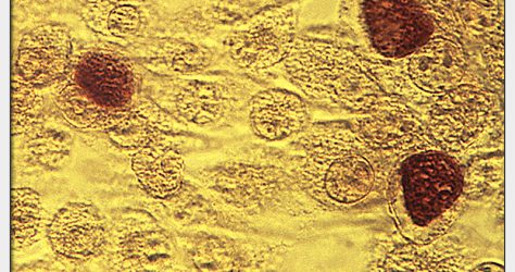 chlamydia trachomatis