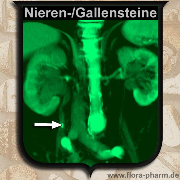 nierensteine-gallensteine-choliton-lithosol