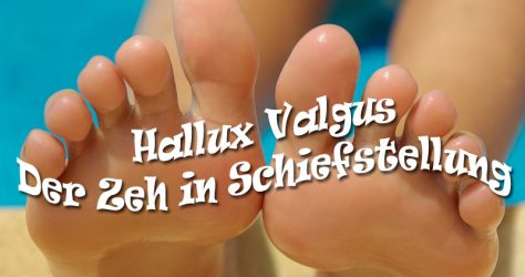 Überbein - Hallux valgus