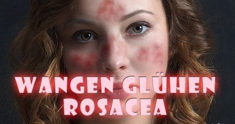 Rosacea - glühende Wangen